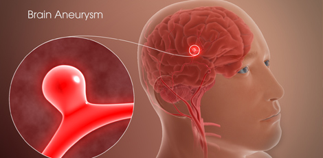 Brain Aneurysm – symptoms, risk factors and treatments etc – Important things to know!!